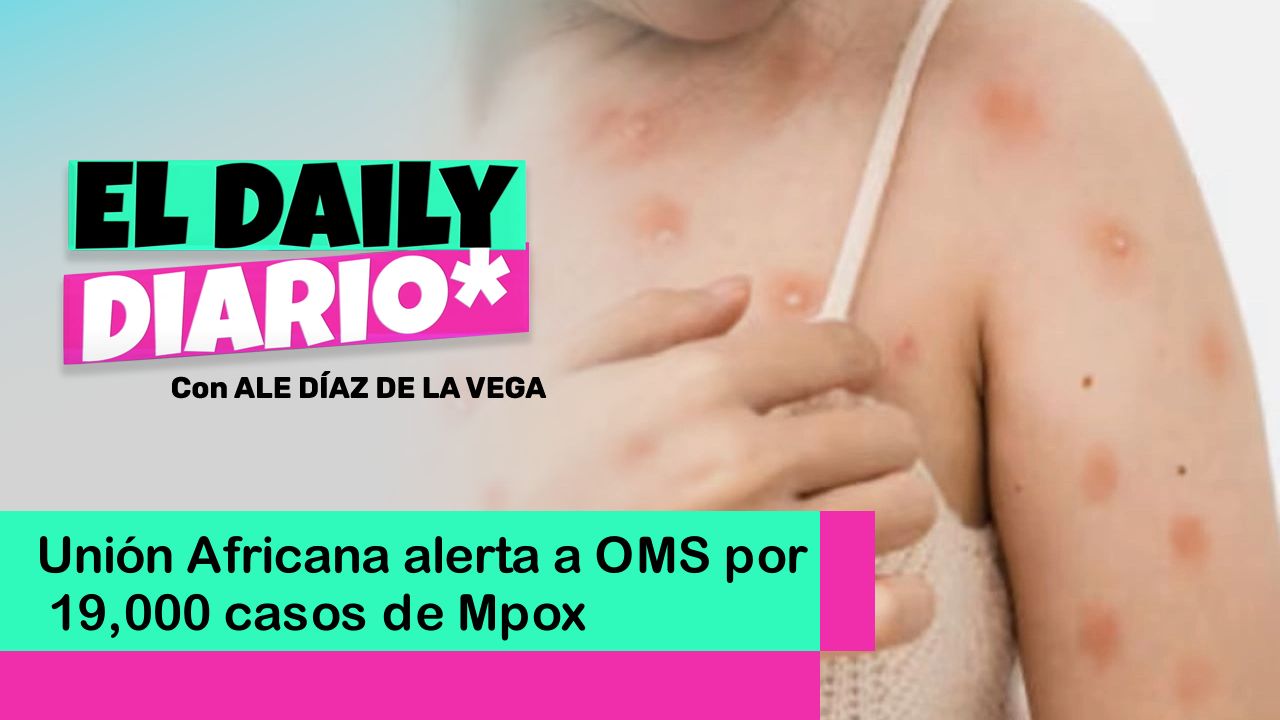 Lee más sobre el artículo Unión Africana alerta a OMS por 19,000 casos de Mpox