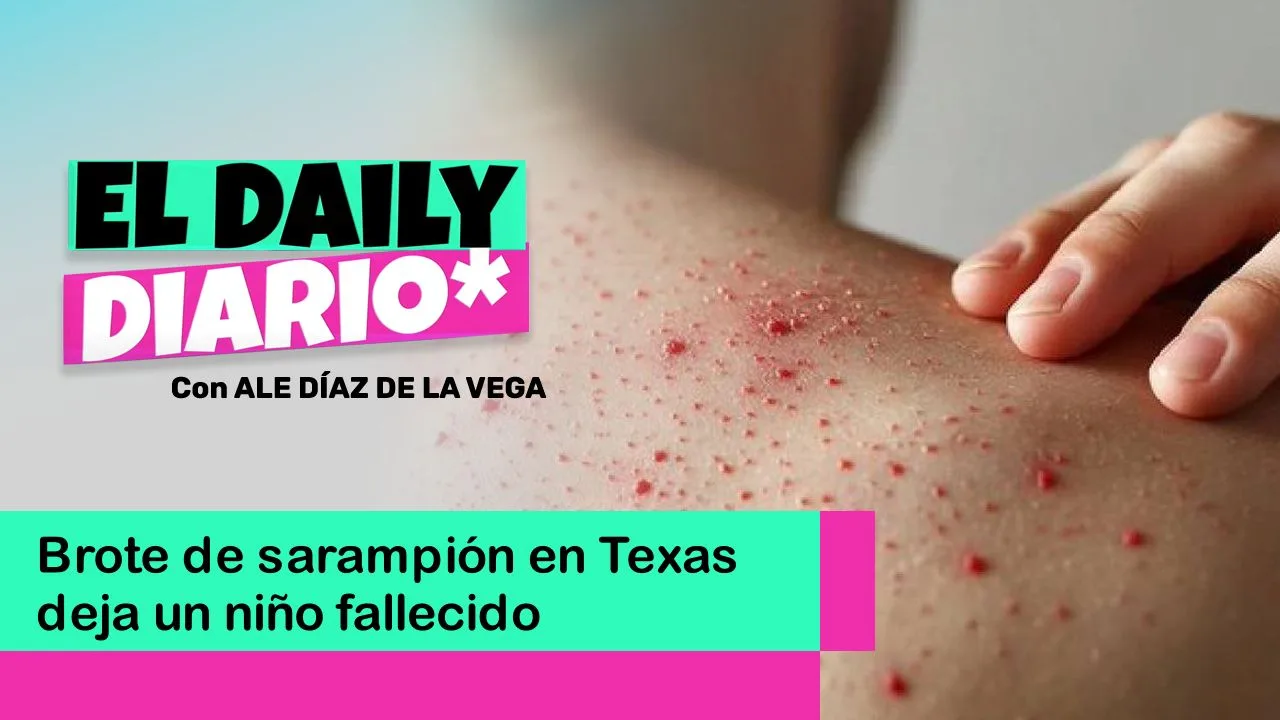 Lee más sobre el artículo Brote de sarampión en Texas deja un niño fallecido